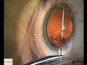 Capsular Bag Repair: Traumatic Cataract With Severe Zonular Weakness