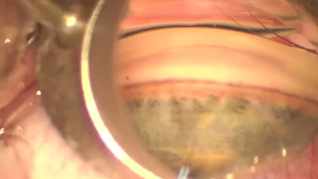 iStent Placement into the Trabecular Meshwork 