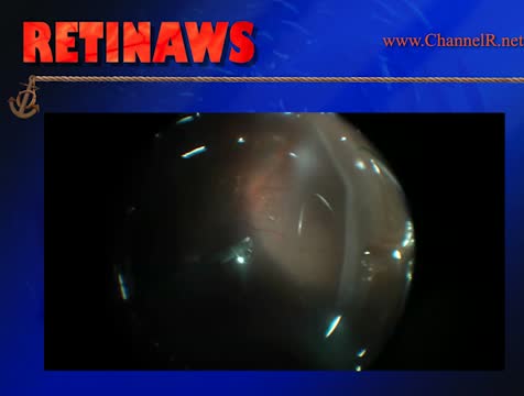 Giant Retinal Tear Detachment