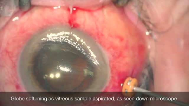 Single-Port Automated Vitreous Biopsy in Suspected Endophthalmitis: A step-by-step guide