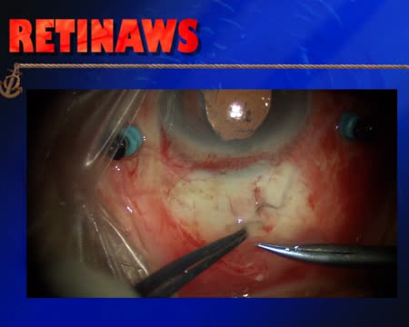 Suprachoroidal Drug Delivery 