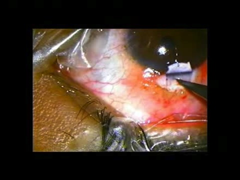 Scleral Flap Retraction Suture for Sclerotomy During Trabeculectomy