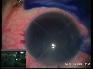 Cataract and PBK in a Phakic IOL and RK Patient