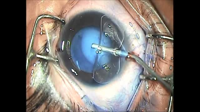 Hydro-PCCC in Congenital Cataract 