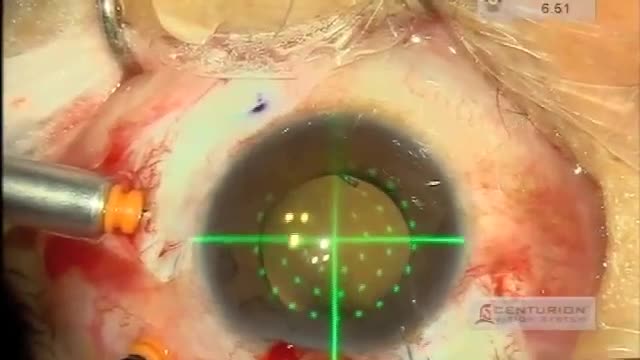 Intrascleral IOL fixation