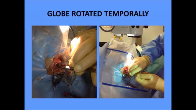 New Approach to Heavy Silicone Oil Removal: Passive Egress Using the Law of Gravity