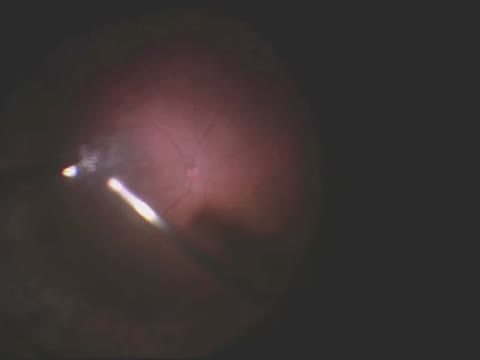 Phaco-Vitrectomy for Cataract With Pseudoexfoliation and Macular Hole