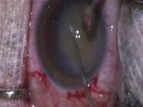 Hypermature Cataract Needle Capsulotomy