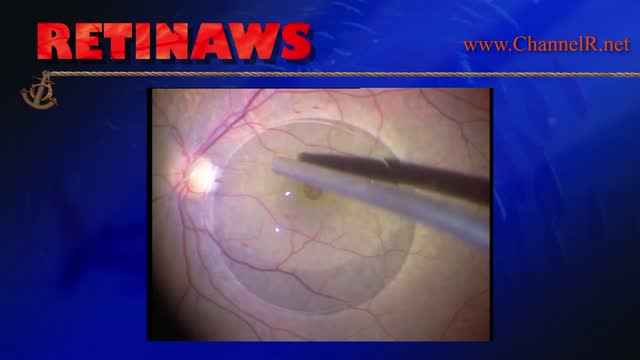 Macular Hole Surgery