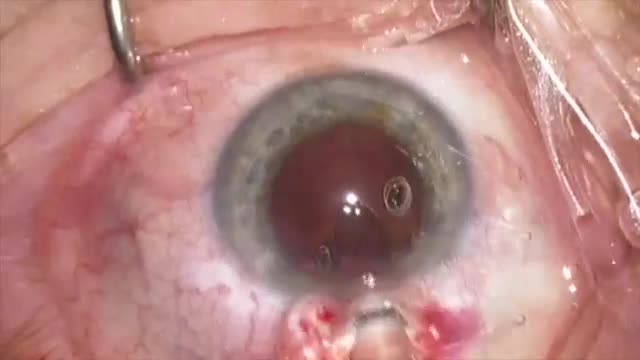 Trulign Z Syndrome: Exchange for Toric IOL
