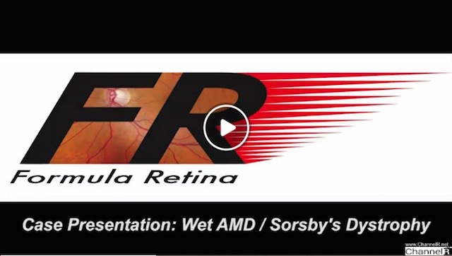 Case Presentation- Wet AMD-Sorsby's Dystrophy