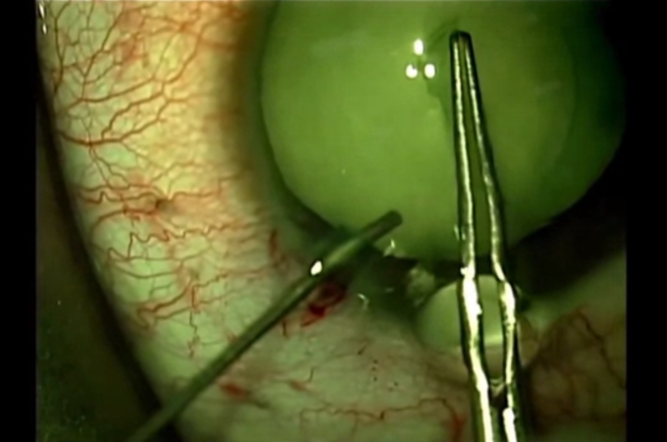 Femtosecond Laser in White Cataract Case