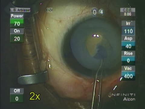 Morgagnian Cataract Extreme Phaco