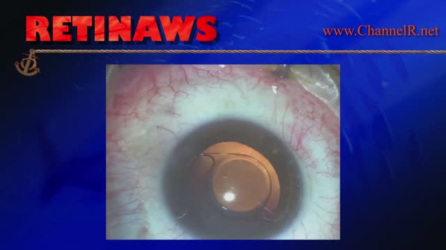 Macular Hole in Rieger's Syndrome