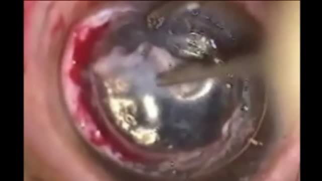 DALK in Corneal Dermoid