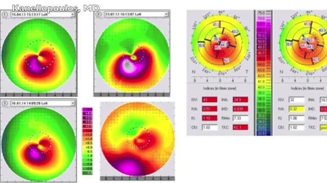 Novel Myopic Refractive Correction With Transepithelial, Very High-Fluence Collagen Cross-linking Applied in a Customized Pattern