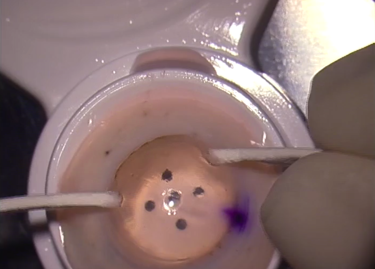 Dr Tan Hybrid DMEK Technique