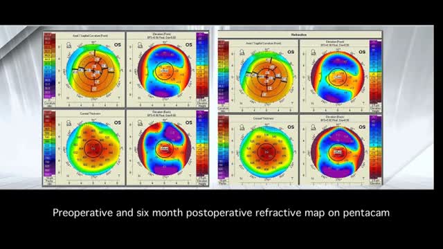 Tailored Stromal Expansion with Refractive Lenticule for Crosslinking an Ultrathin Cornea