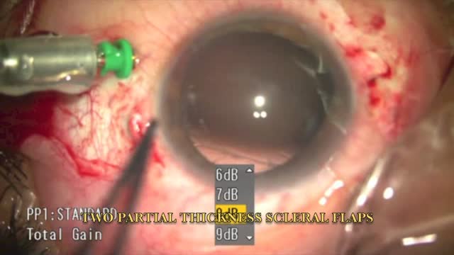 Glued IOL Live Surgery Unplugged: Trials & Tribulations