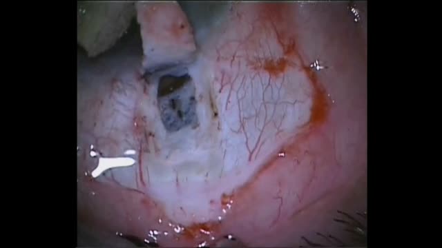 Eslam Approach: Combined Viscocanalostomy and Transciliary Filtration