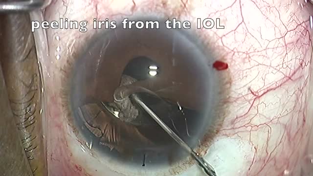 Iridoplasty using the SWEET technique