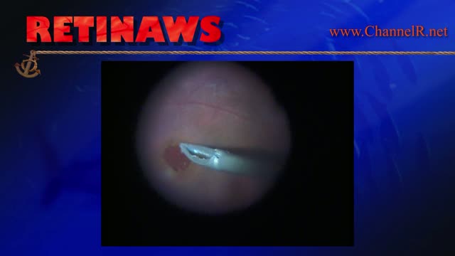 Macular Hole