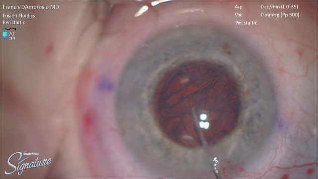 Cortex Removal with Catalys