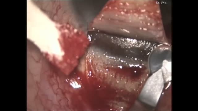 Different Types of Suprachoroidal Implants
