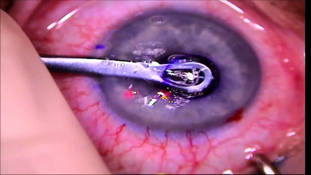 Combined Z-LASIK and KAMRA Inlay