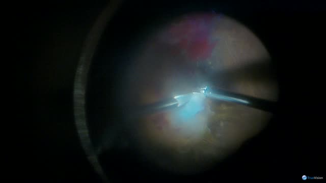 Heads-up 3-D Vitrectomy for Diabetic TRD
