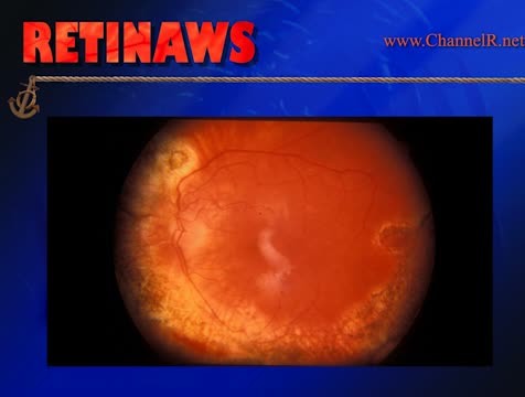 Perforating Injury