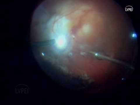 Dye Diffusion Technique for High Myopic Retinal Detachment
