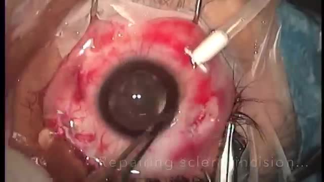 Teflon Wrapping for IOFB Removal
