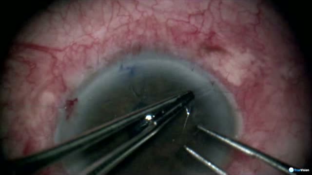 Pupilloplasty/Iris Repair Using a Modified Siepser Sliding Knot