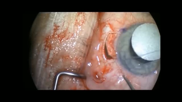 Low Pressure Surgery: The Cleft That Won't Go Away