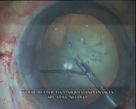 Glued Capsular Hook