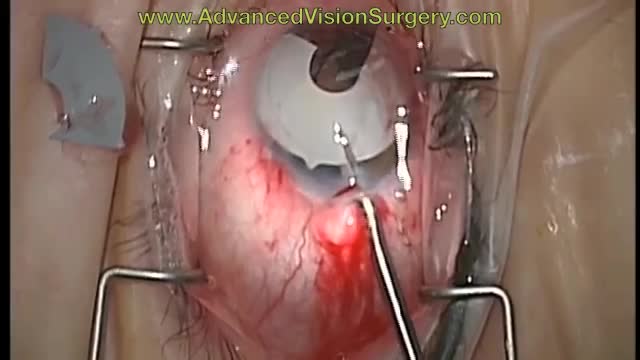 Bright Ocular Cosmetic Iris Implant Removal