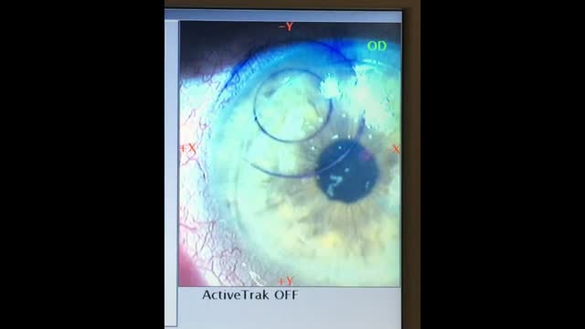 Flap Lift With the iFS Advanced Femtosecond Laser