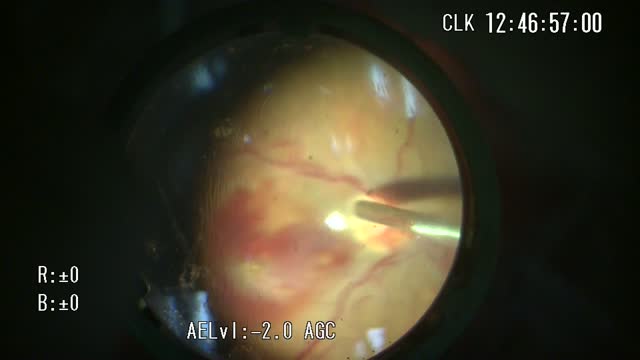 Displacement of Subfoveal Hemorrhage by Perfluorocarbon