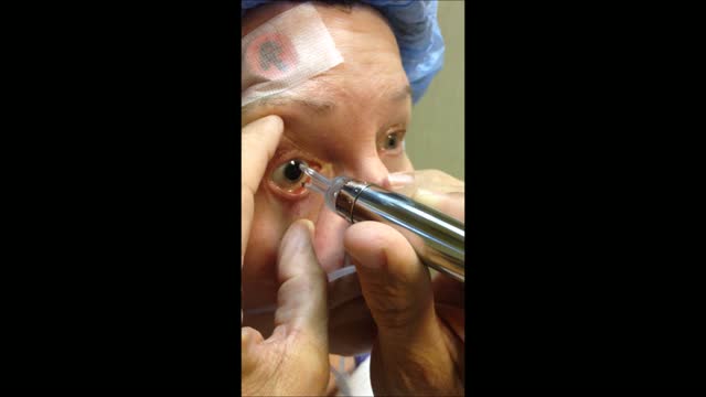 Toric IOL in a Patient Who Had Prior Radial Keratotomy