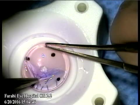 Shaving Technique in DMEK Tissue Harvesting