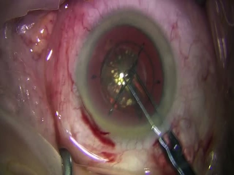 Translenticular Hydrodissection in Femtosecond Laser Cataract Surgery
