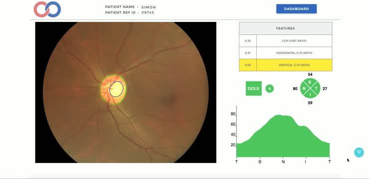 Automatic Glaucoma Analyzing Software