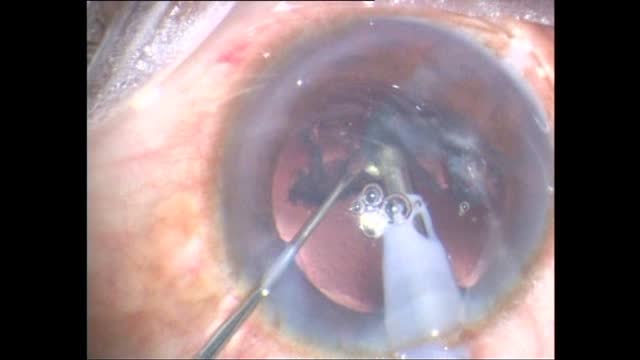Conquering with Polar Tricks: Managing a Posterior Polar Cataract