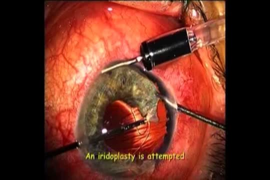 Save the Iris! (Management of Traumatized Iris)