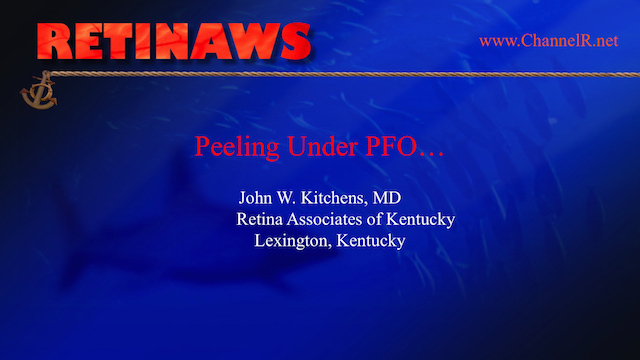 Peeling Under PFO