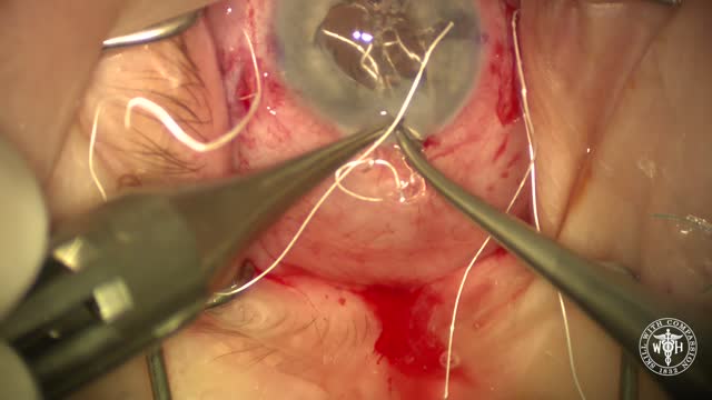 IOL Exchange With Gore-Tex-Sutured AO60 IOL