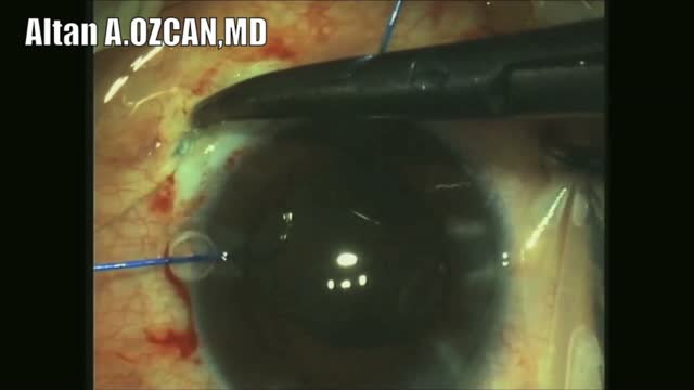 Bi-lateral Subluxed Crystalline Lens