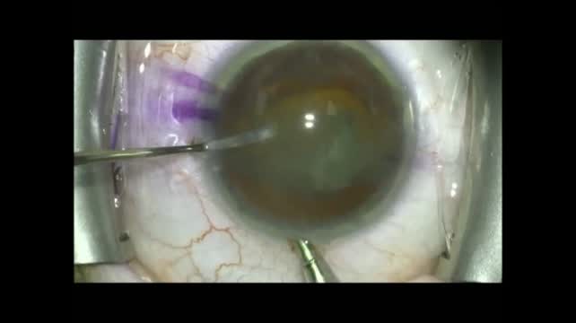 Supra Capsular Technique - Rotate to Flip Lens