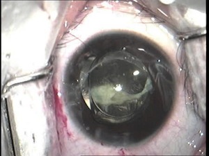 Capsular Bag Re-opening and PCIOL Implantation in Aphakic Child